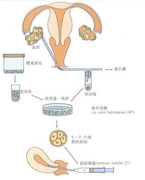 泰国私立供卵试管技术能否防止NF1微缺失综合症遗传给后代？