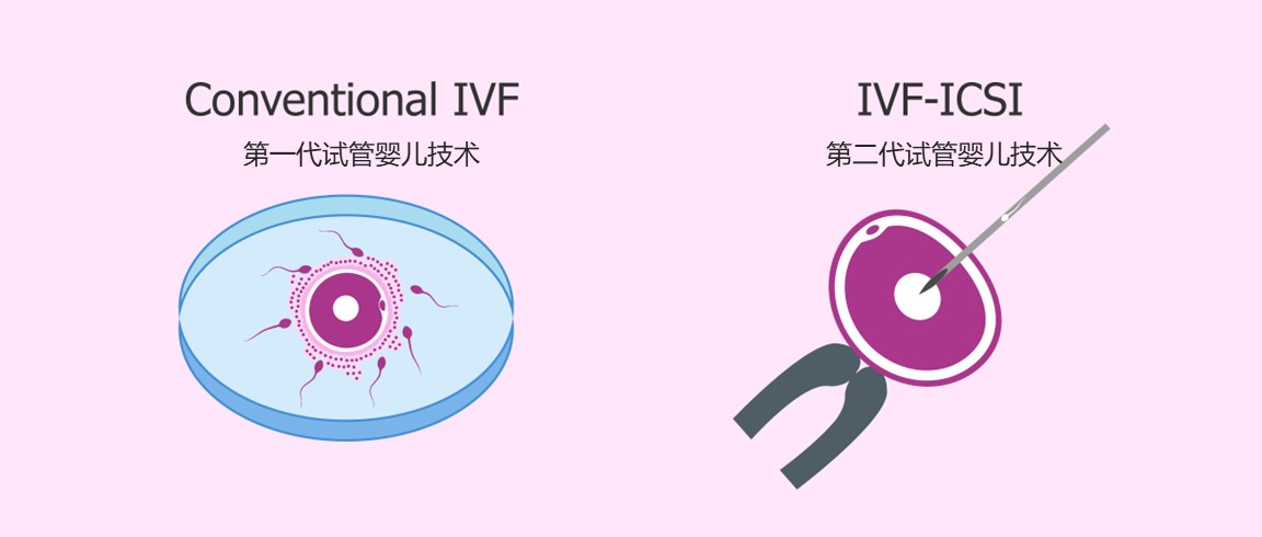 供卵试管婴儿促排方案影响精卵吗